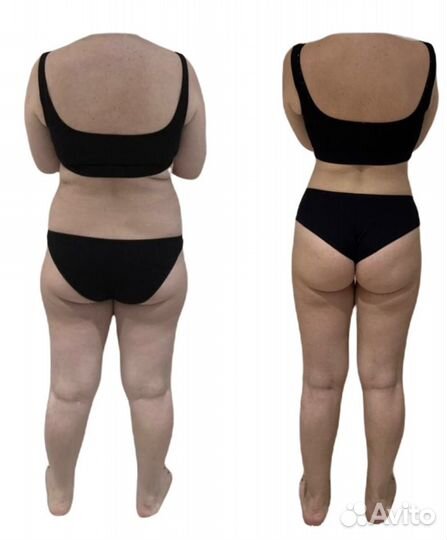 Антицеллюлитный массаж, lpg, похудение, эпиляция л