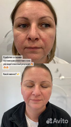 СМАС лифтинг подтяжка лица