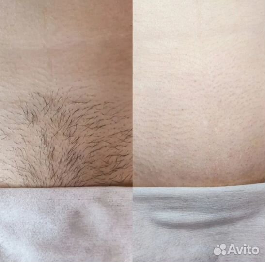 Эпиляция,депиляция: мужчин и женщин