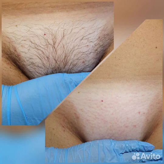 Восковая депиляция(мужская/женская)