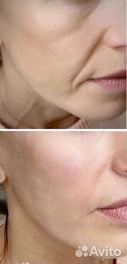 Массаж липопластика лица и тела