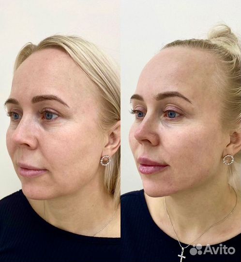 Модель на увеличение губ, углы Джоли