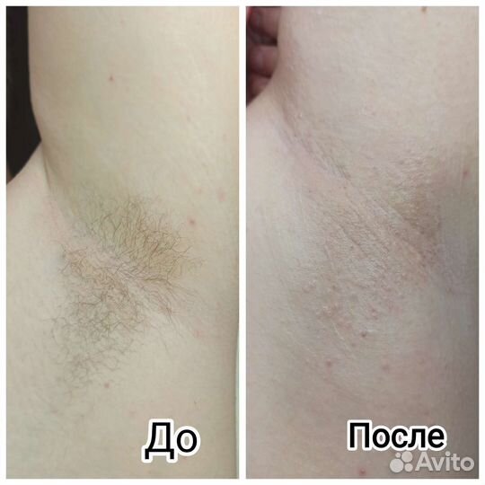 Шугаринг депиляция