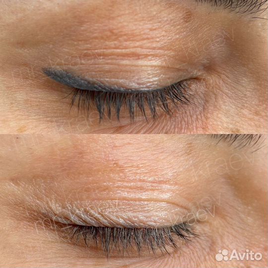 Удаление татуажа, перманента бровей, век, губ