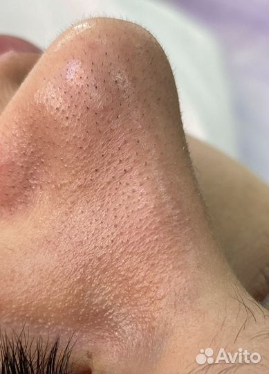 Уз чистка лица