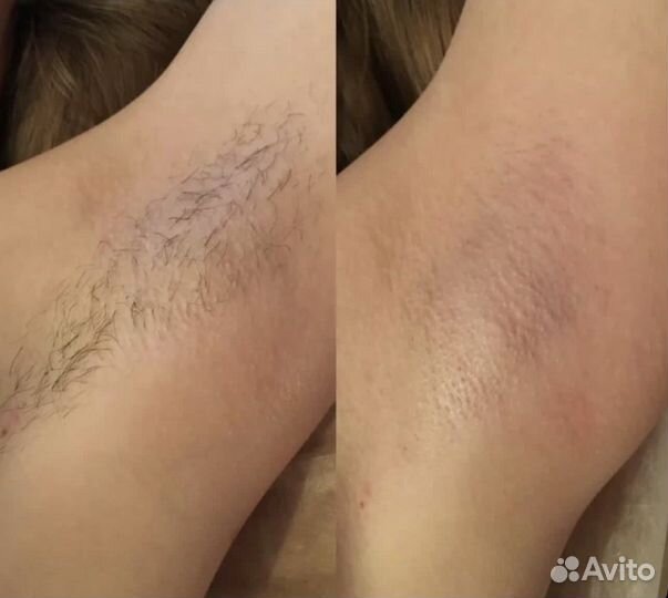 Шугаринг депиляция