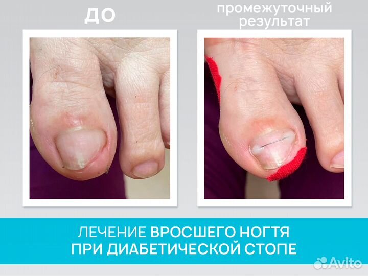 Подолог, медицинский педикюр при сдс, обработка