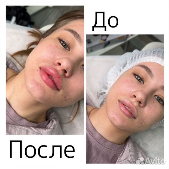 Увеличение губ контурная пластика косметолог