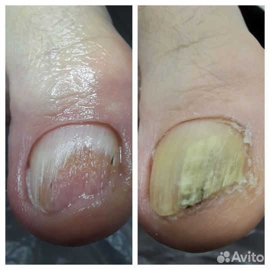 Подолог-вросший ноготь,стержневая мозоль