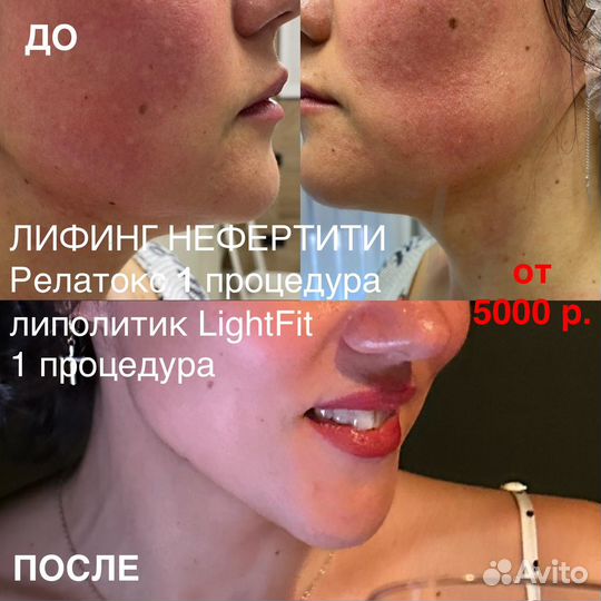 Лифтинг нефертити/ безопасная подтяжка овала лица