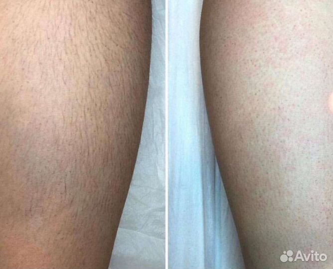 Лазерная эпиляция Парнас