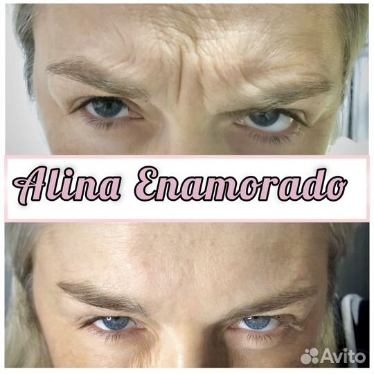 Нужны модели на ботокс