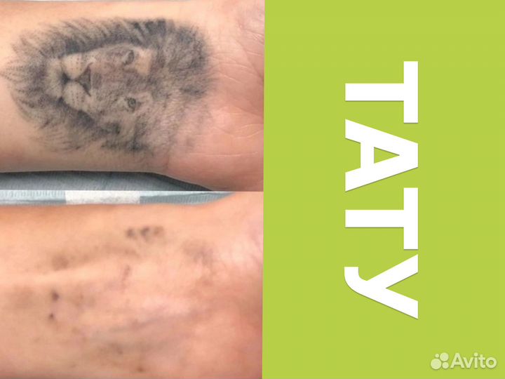 Лазерное удаление татуировок и татуажа