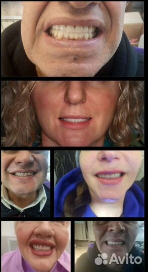 Съемные и несъмные зубные протезы,коронки,ремонт