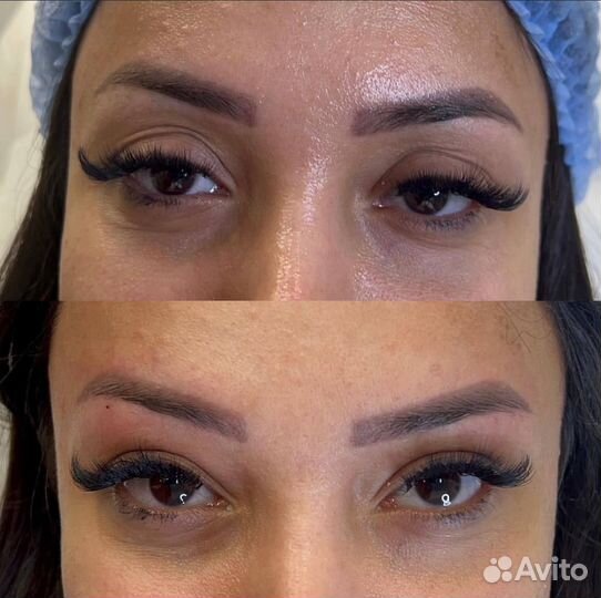 Инъекции ботокса в подмышки