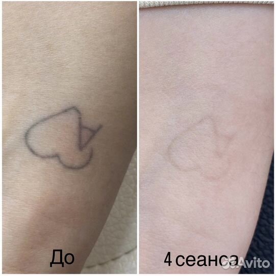 Удаление татуировок