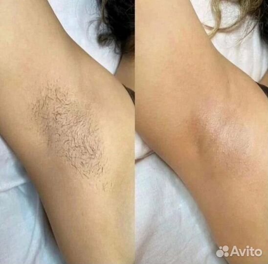 Лазерная эпиляция