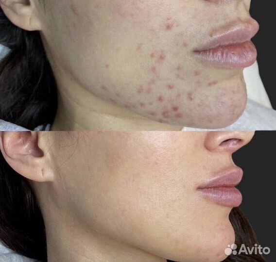 Средство от прыщей/акне/угревой сыпи