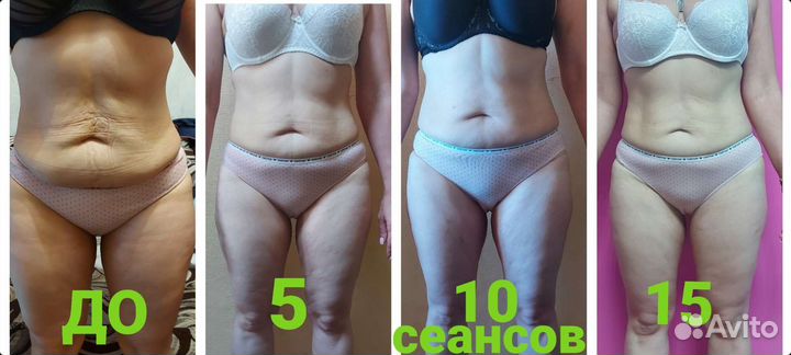 LPG массаж канавино