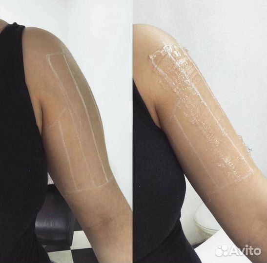 Модель на лифтинг аппаратом Ультраформер 3