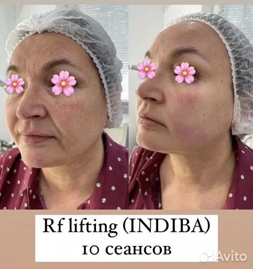Нужна модель RF lifting (Indiba) массаж лица