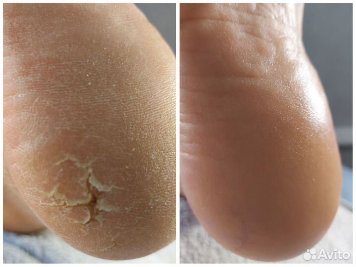 Педикюр(Smart)