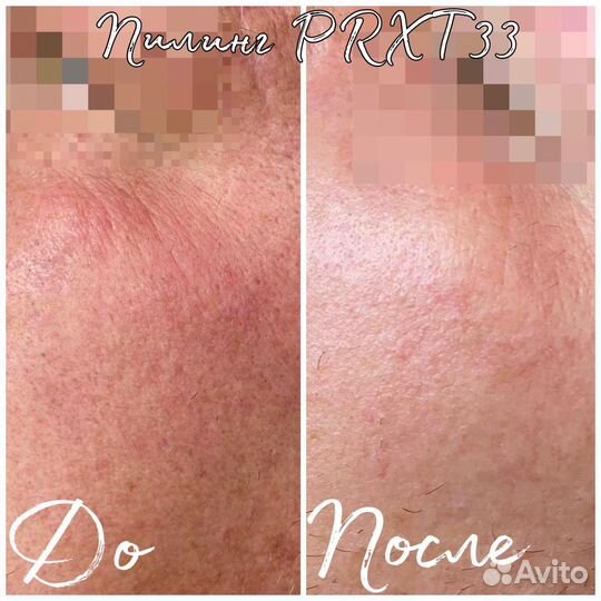 Косметолог: чистка, пилинг, мезотерапия