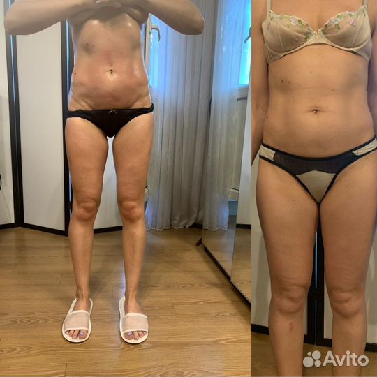 Антицеллюлитный массаж