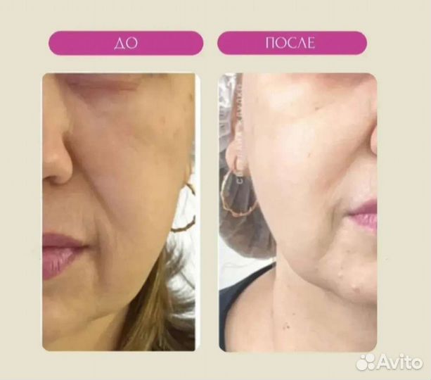 Контурная пластика