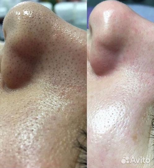 Косметолог Чистка лица