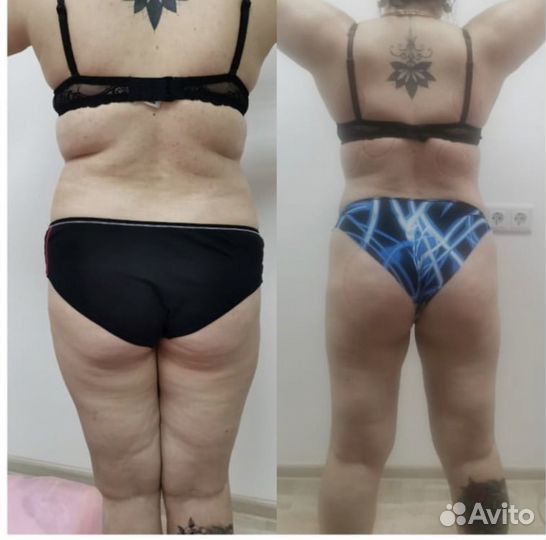 Коррекции фигуры (аппаратная и много др)