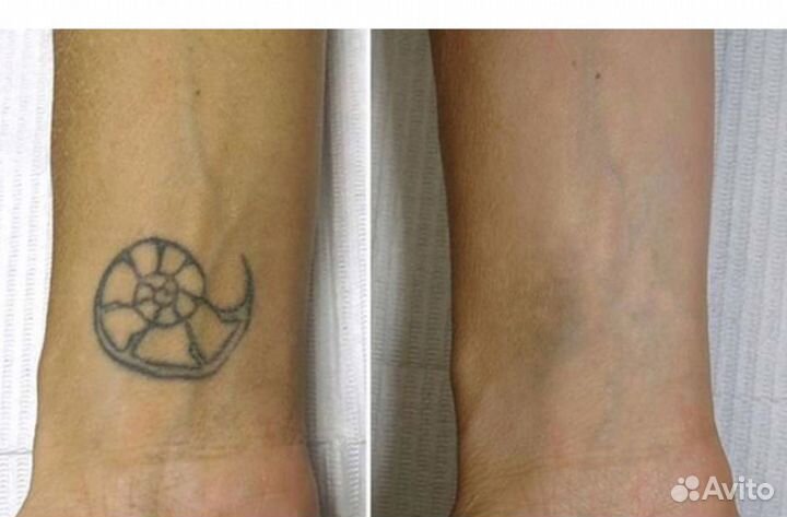 Удаление тату и татуажа