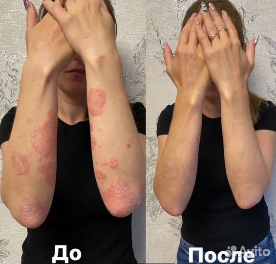 Средство от псориаза