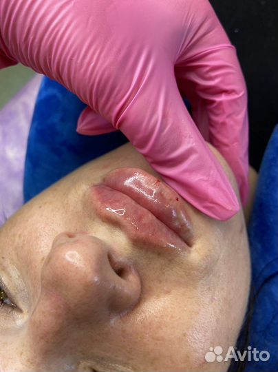 Модель на увеличение губ