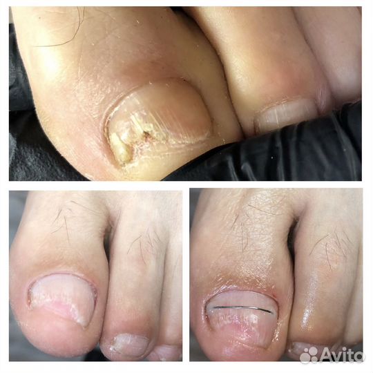 Подолог,медицинский педикюр,титановая нить