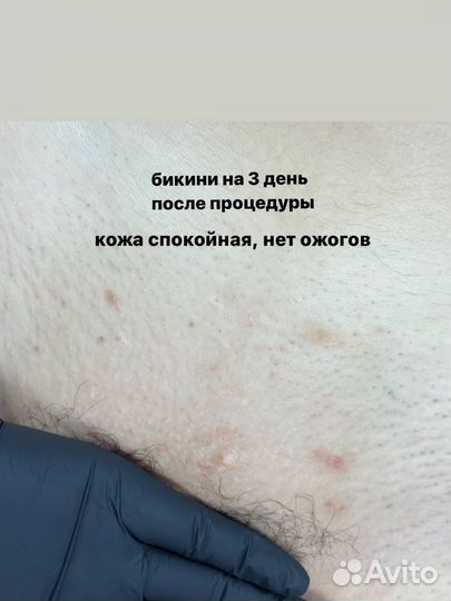 Электроэпиляция