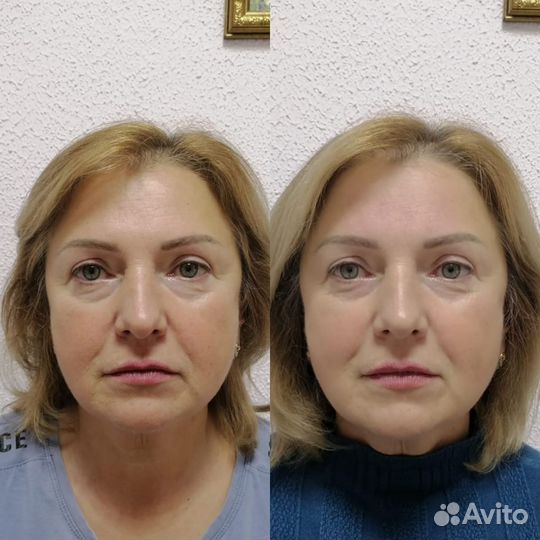 Буккально-скульптурный массаж лица