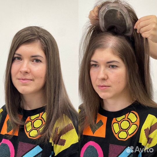 Система замещения волос при алопеции модель