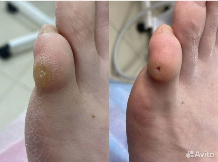 Подолог Медицинский педикюр Выезд на дом