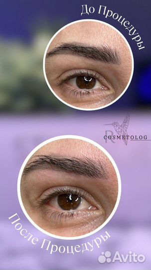 Модели на лазерное удаление Тату и перманента