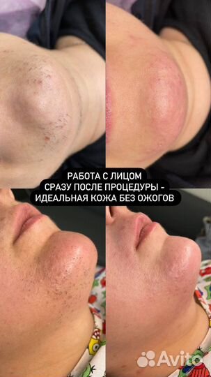 Электроэпиляция