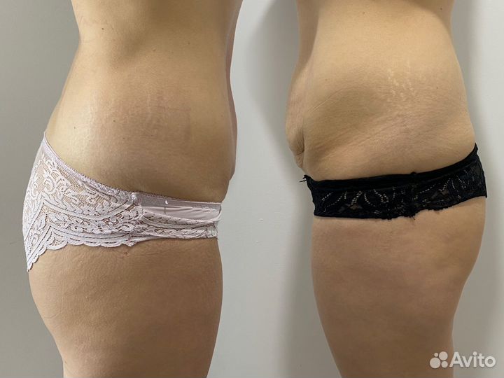 Вакуумный массажер для тела vellashape v8c1