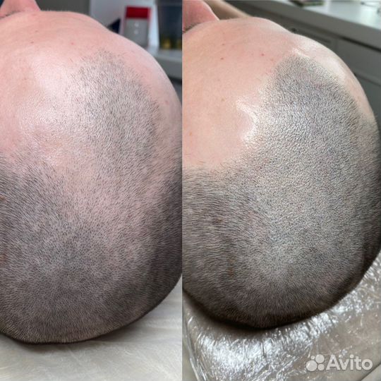 Трихопигментация для мужчин и женщин