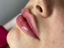Увеличение губ, ботокс