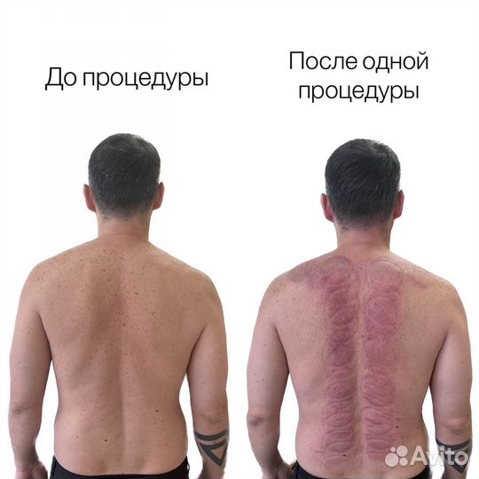 Лечение позвоночника.Массаж Гуаша