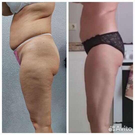 Коррекция фигуры - эффективное похудение