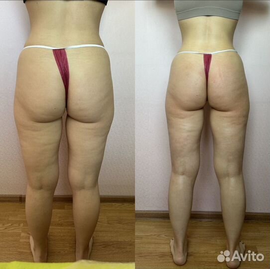 Антицеллюлитный массаж ручной