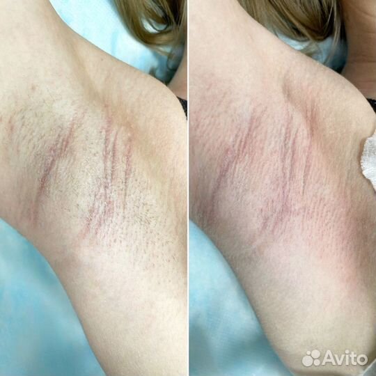 Депиляция/электроэпиляция