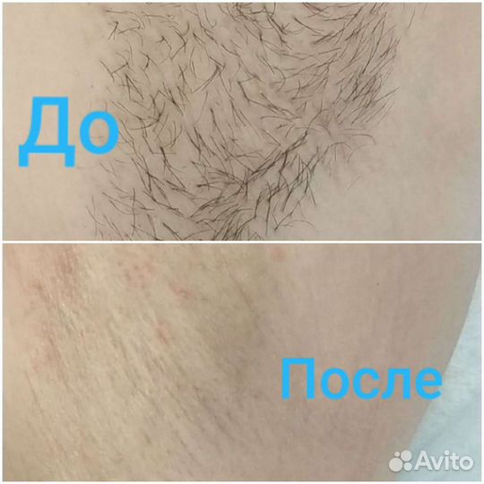 Электроэпиляция