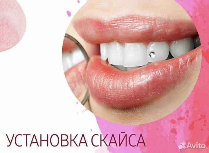 Установка Скайс